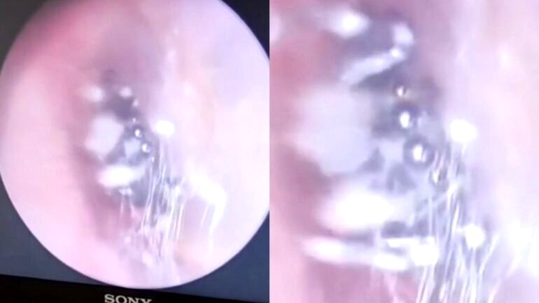 Video: Doctor in China discovers live spider nesting inside woman’s ear