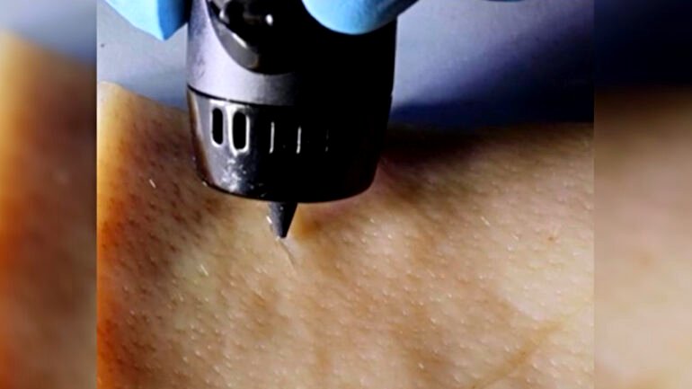 Chinese scientists develop ink that heals wounds via 3D-printing pen