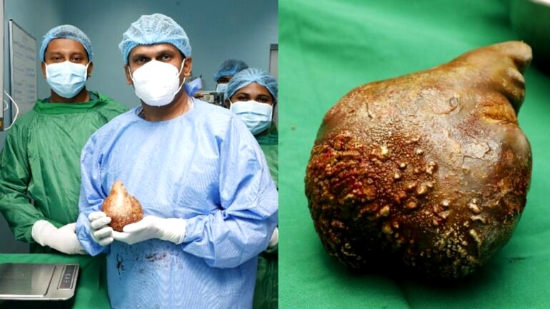 Sri Lankan man breaks Guinness World Records for largest, heaviest kidney stone