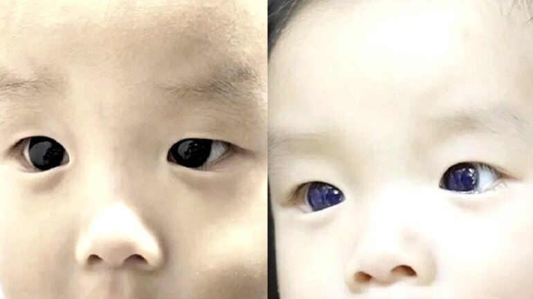Thai baby’s dark brown eyes turn indigo blue after COVID-19 treatment