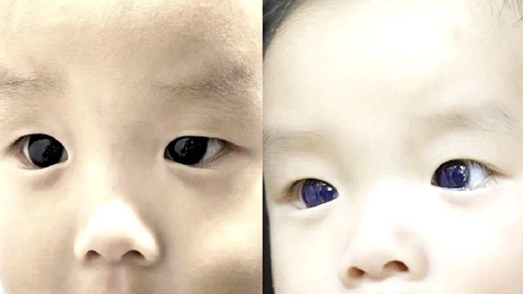 Thai baby’s dark brown eyes turn indigo blue after COVID-19 treatment